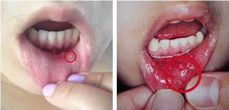 吃白瓜溃疡疼,探究原因与防治策略